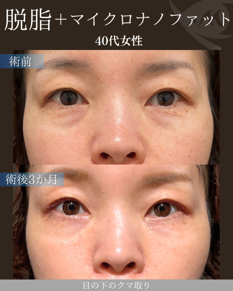 40代女性 脱脂＋マイクロナノファット 3ヶ月後